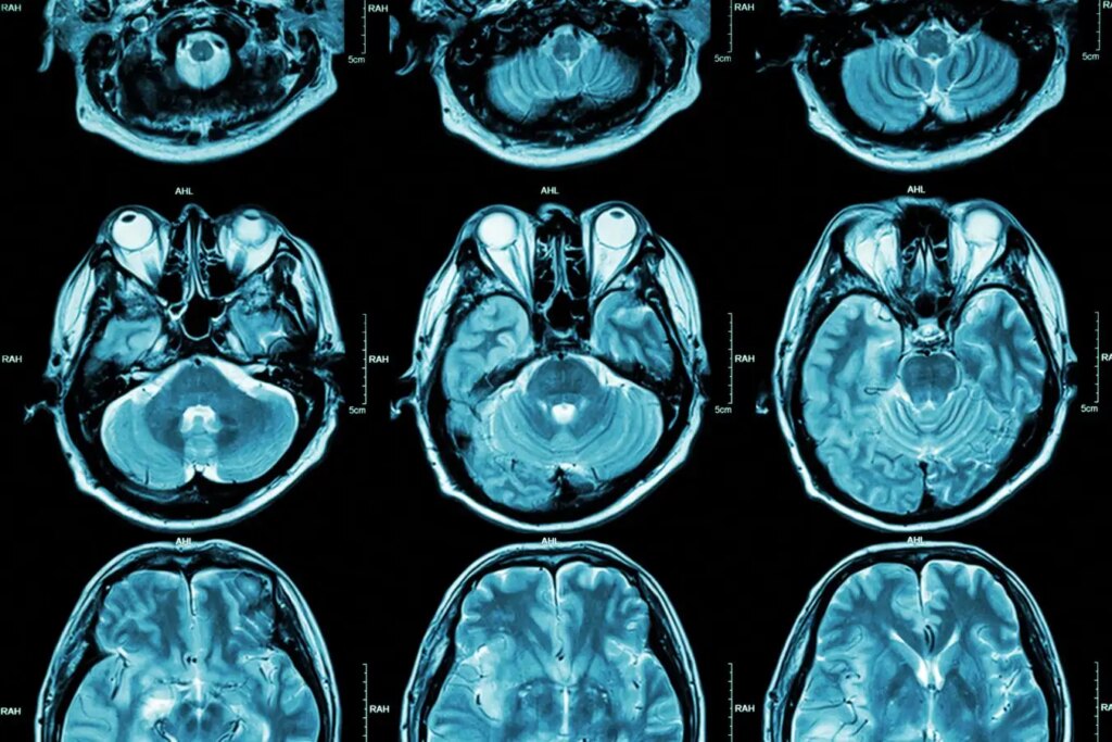 Exploring Two Distinct Autism Subtypes Identified by Unique Brain Activity Patterns