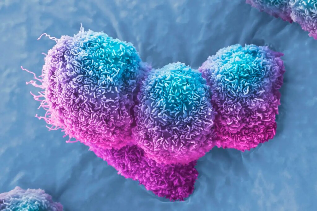 Viral Injections Show Promising Results in Halting Pancreatic Cancer Progression in Three Patients