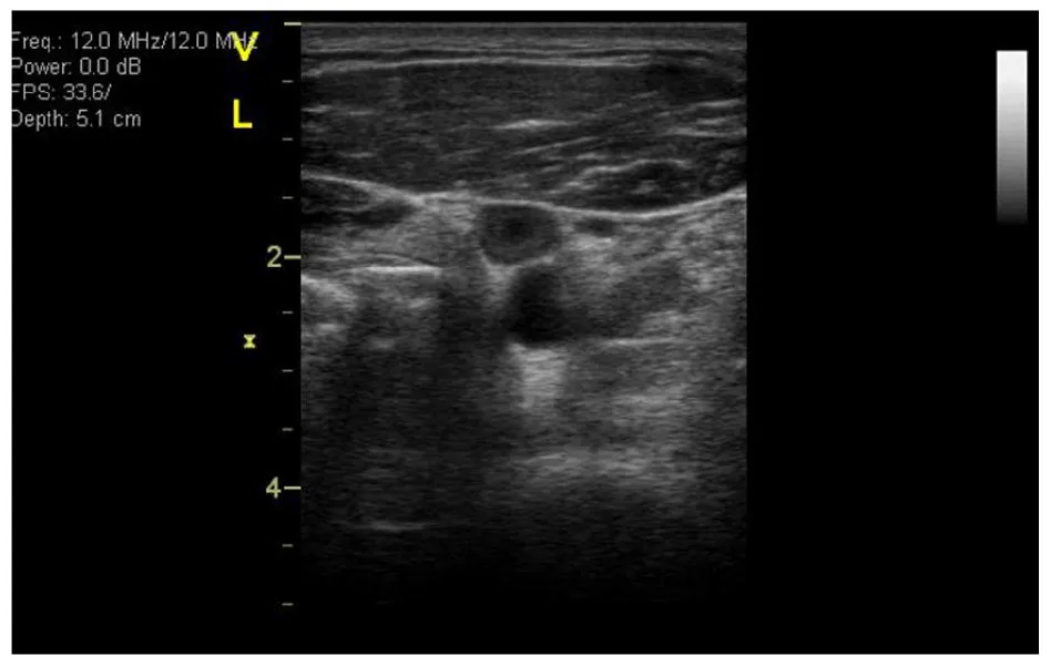 Optimized Algorithm for Assessing VTE Risk Scores in Astronauts: A Comprehensive Guide