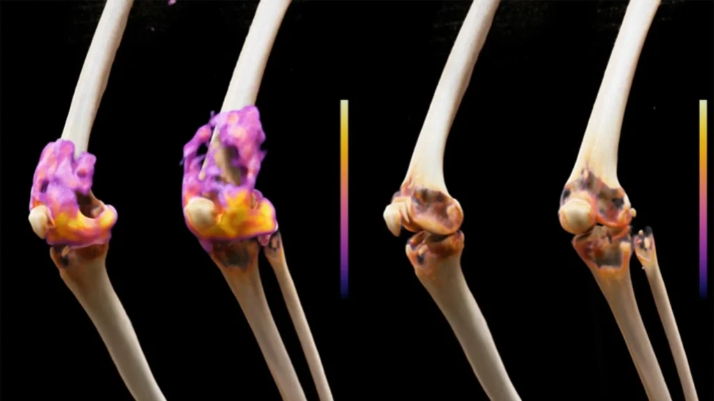 Severe Rheumatoid Arthritis Goes Into Remission After Cancer Treatment