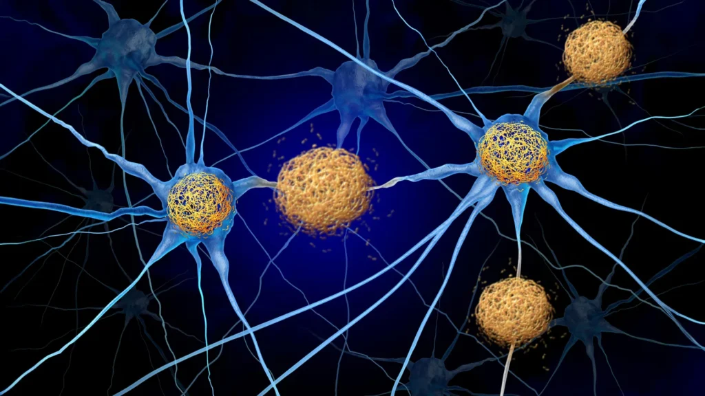 Alzheimer’s Disease Brain Changes Can Begin Years Before Plaques Appear