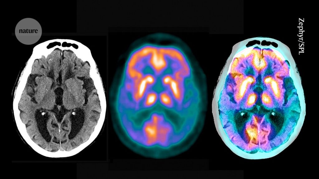 Brain’s Tiny Proteins May Offer New Clues About Alzheimer’s Disease