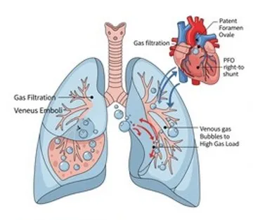 Decompression Sickness and Venous Thromboembolism During Spaceflight: Impact of Patent Foramen Ovale