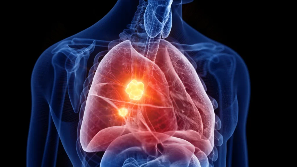 New Mesothelioma Drug Turns Cancer’s Own Defenses Against the Disease