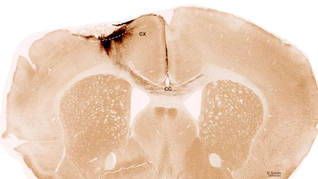 Stem Cell Therapy Reverses Stroke Damage and Restores Movement in Mice