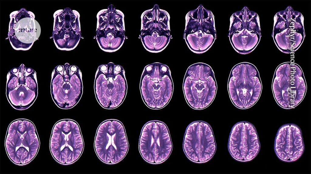 Childhood Brain Development Predicts Teenage Depression and Anxiety
