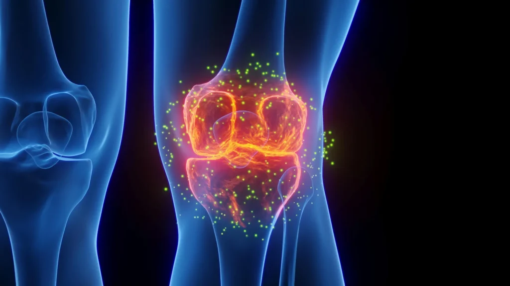 FDA-Approved Epilepsy Drug May Help Reverse Osteoarthritis Damage, Study Finds