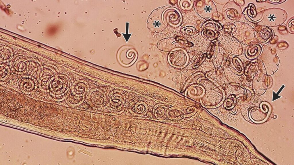 Insects Mating Inside a Human Eye: Larvae Removed Just Before They Emerge