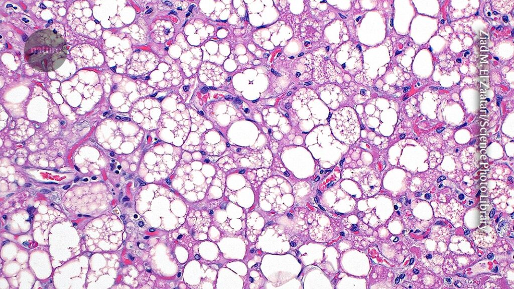 Overlooked Brown Fat in the Body Linked to Numerous Health Benefits